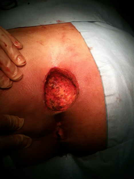 Excision Kyste Pilonidal et cicatritation rapide avec pose de VAC dr SALSANO Montpellier