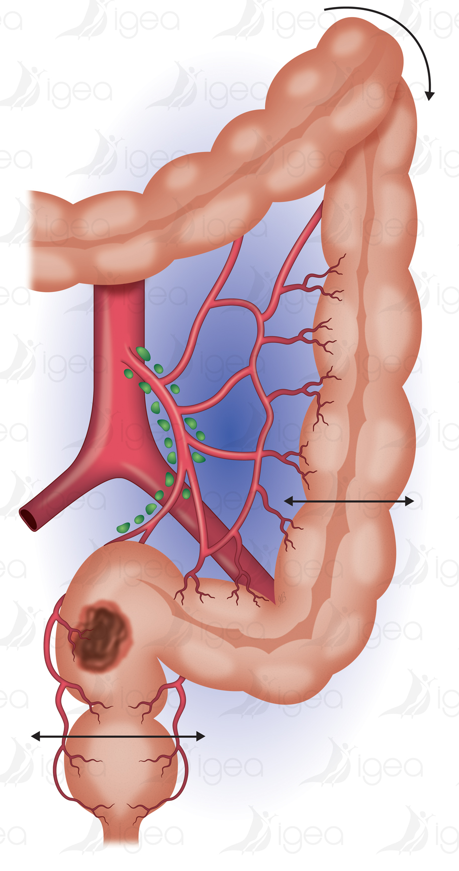 cancer du rectum - Montpellier - Dct Salsano Chirurgie digestive - 34