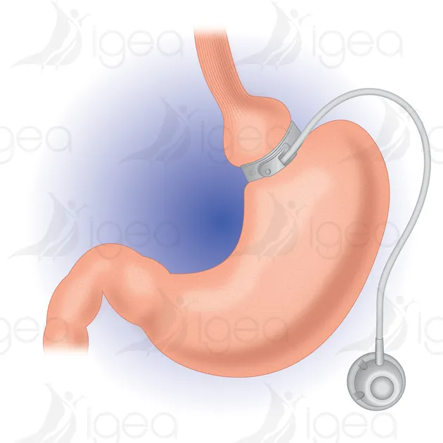 2-Blu-anneau-gastrique- Anneau gastrique infographie igea