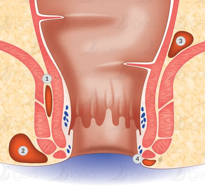 abcses-anal (1) abcès anale schema centre Igea chirurgie proctologique