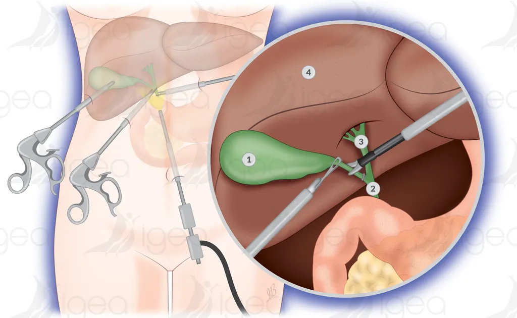 ablation-vesicule-biliaire ablation de la vésicule biliaire