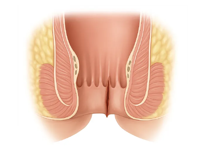 fissure_anale fissure anale schema igea