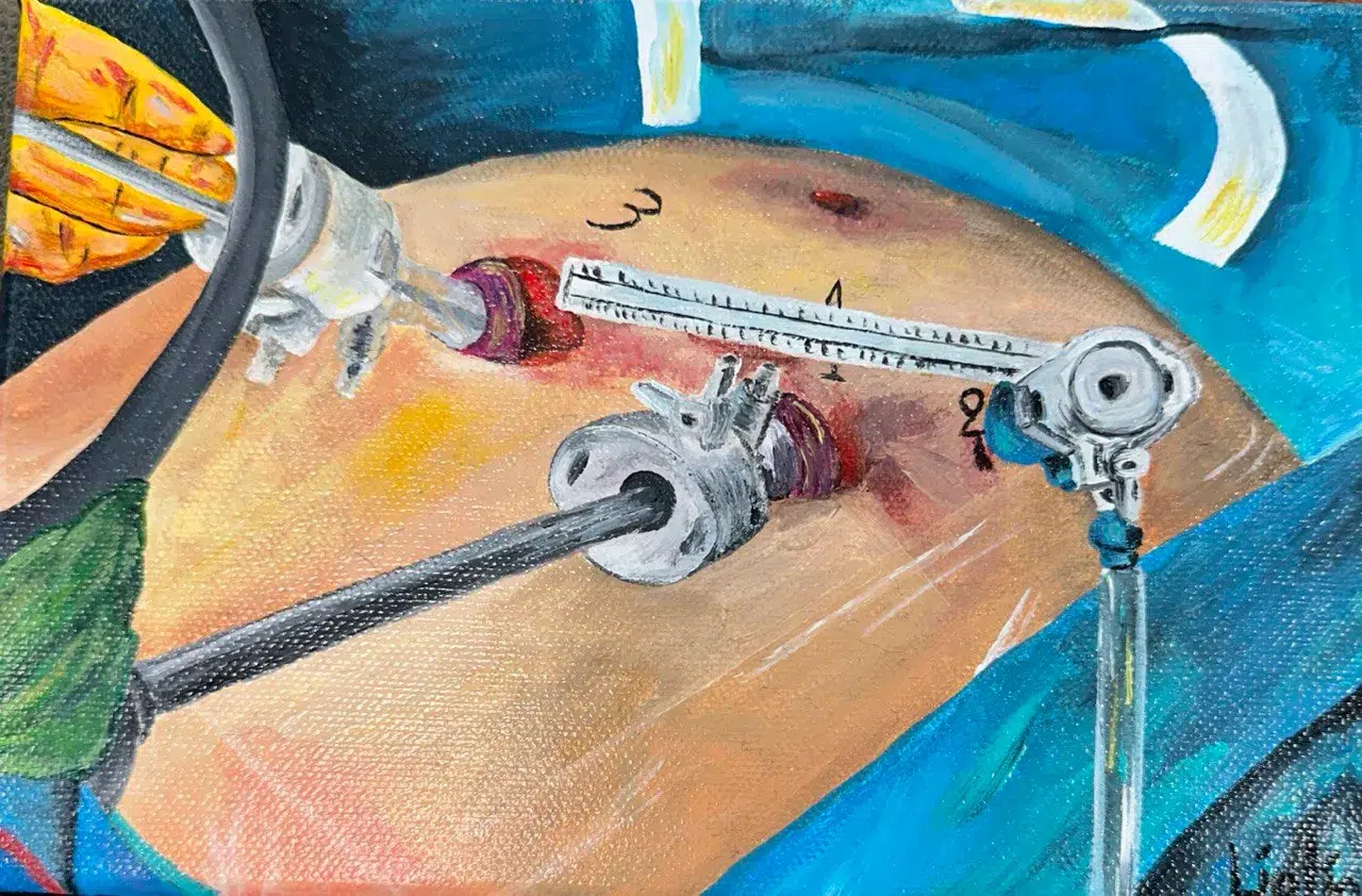 laparoscopie laparoscopie pour une splénectomie