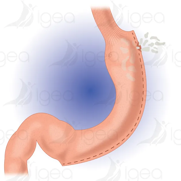 sleeve-gastrectomie-complication-fistule sleeve gastrectomie