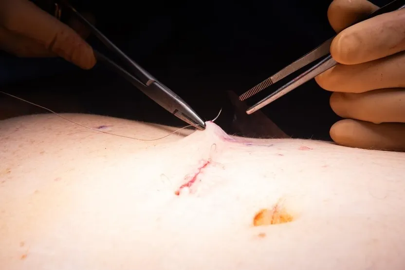 suture cure hernie ombilicale suture cure hernie ombilicale