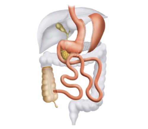 Sleeve gastrectomie avec bipartition du transit anastomose gastro-ileale
