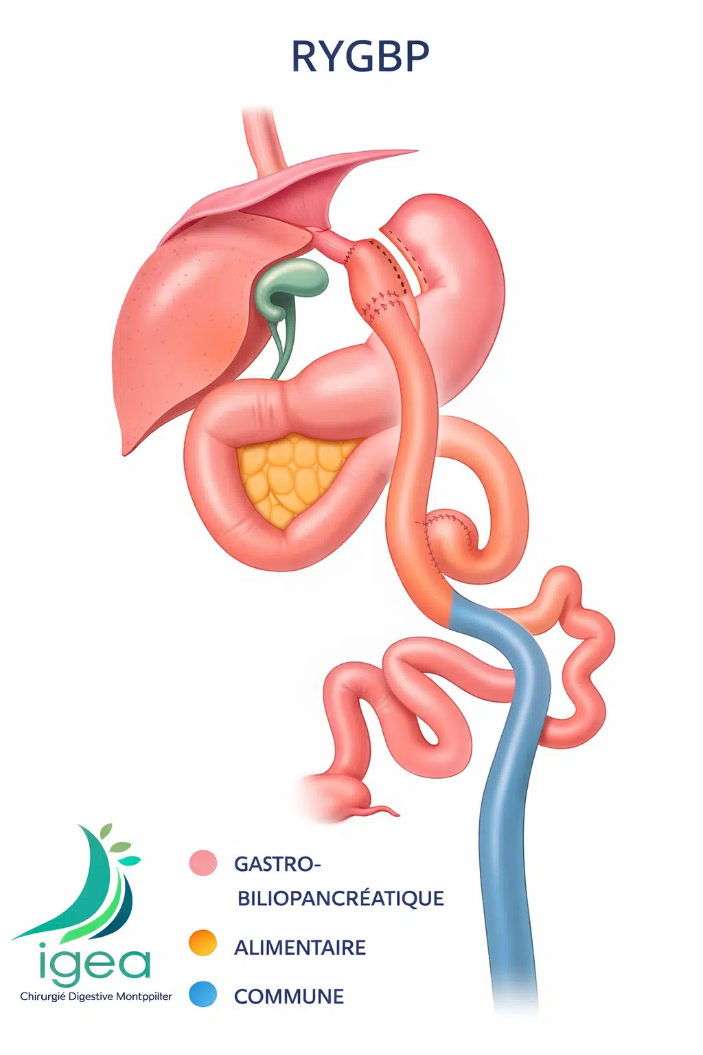 Bypass gastrique en Y (RYGBP) après échec de Sleeve