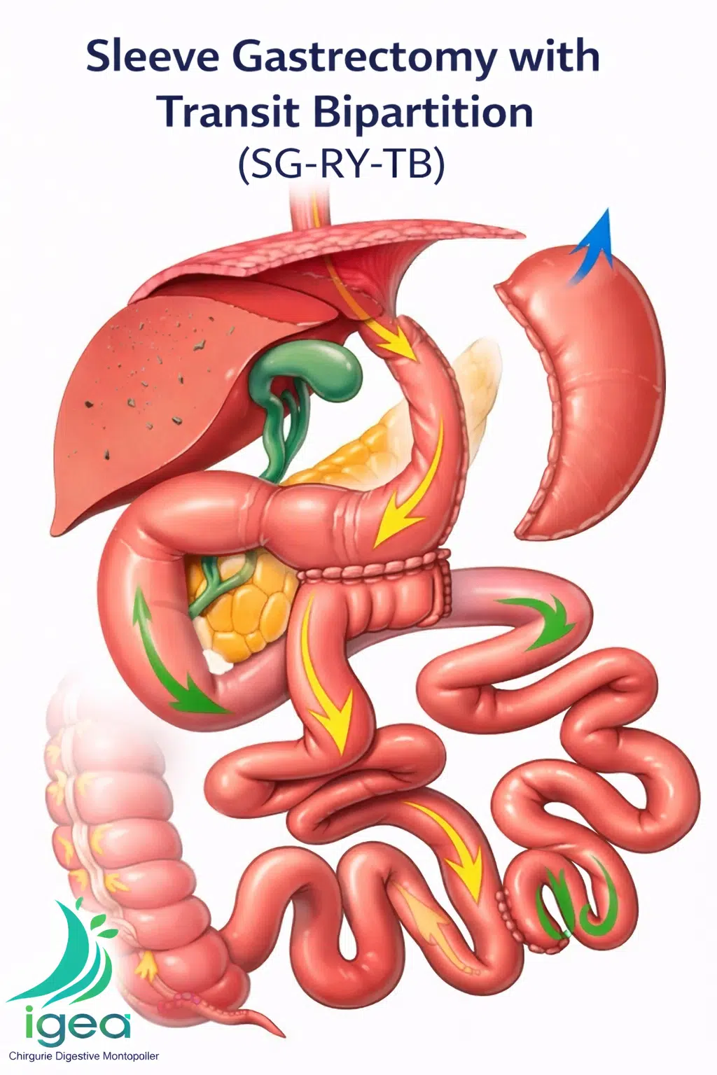 Sleeve gastrectomie avec bipartition du transit (SG‑RY‑TB) - •	chirurgie de révision après sleeve