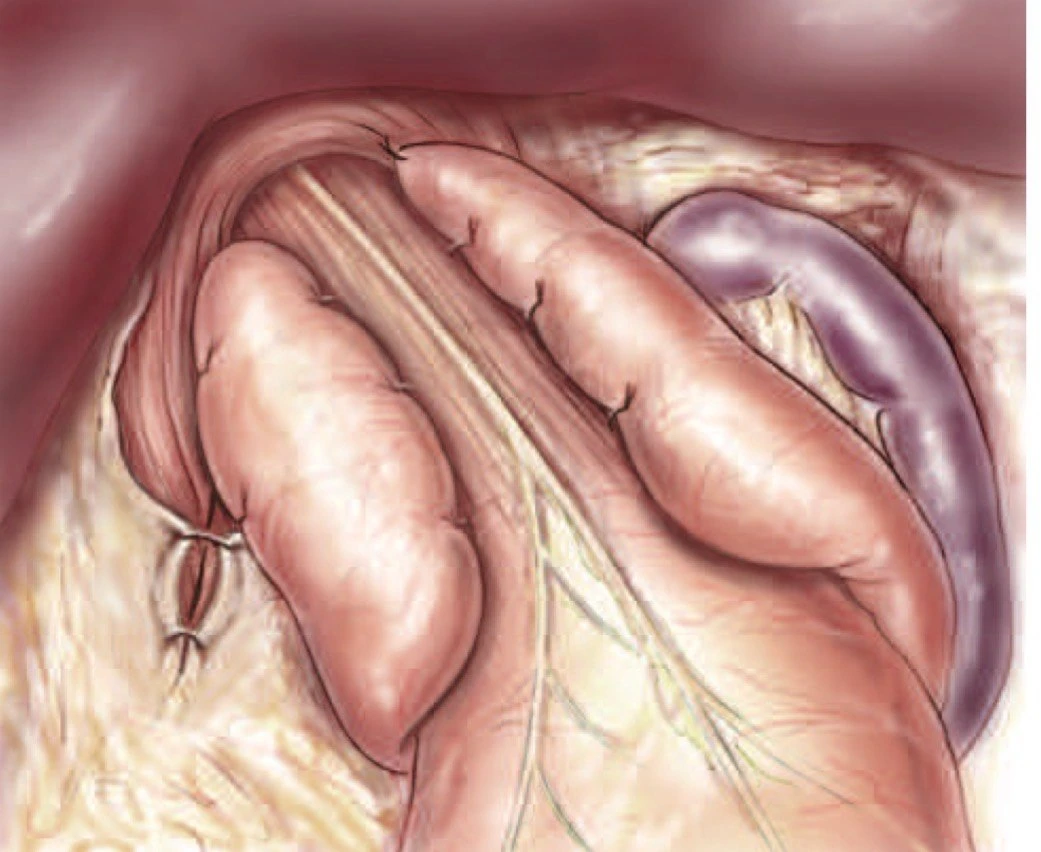 Chirurgie du reflux gastro-œsophagien technique d'intervention Fundoplicature selon Nissen a 360