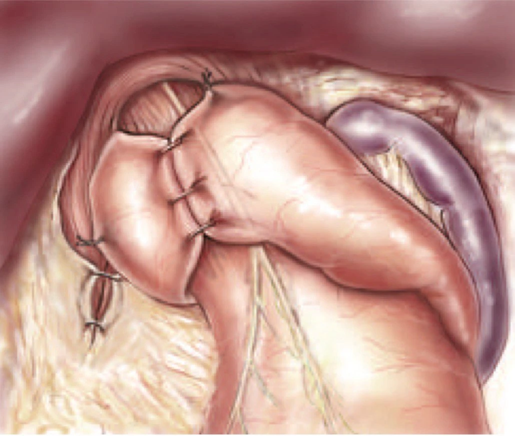 Chirurgie du reflux gastro-œsophagien technique d'intervention fundoplicature selon Toupet a 270