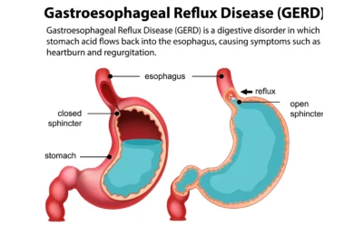 Chirurgie du reflux gastro-œsophagien (RGO) et hernie hiatale à Montpellier