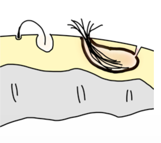 kyste pilonidal schema